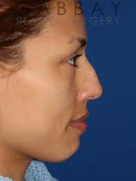 Chin Augmentation Beverly Hills Chin Implants In Los Angeles