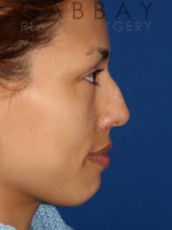 chin augmentation beverly hills chin implants in los angeles