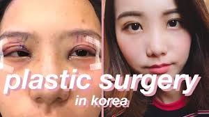 South korean eye surgery anime. Double Eyelid Surgery Recovery Vlog Gangnam Seoul South Korea Youtube