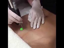 Hair removal can be annoying sometimes because of the time and patience required to eliminate every string of hair from your public areas. Bikini Laser Hair Removal Nyc Romeo Juliette Laser Hair Removal