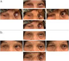 Modified partial Jensen procedure to treat a hypertropic Knobby eye  syndrome in a high myopic monocular patient
