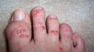 Image result for ant bite