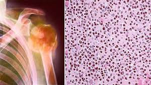 What blood tests indicate multiple myeloma. How Multiple Myeloma Is Diagnosed Everyday Health