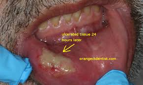 Lip Biting While Numb Photos Calcaterra Family Dentistry Orange