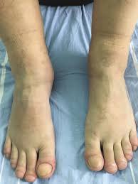 Image result for Clubbing nails feet