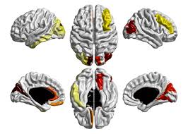In the past, there were different kinds of autism disorders, but in 2013 the criteria for autism. Diagnosing Autism Using Brain Scans Mapping Ignorance
