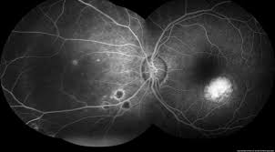 Presumed Ocular Histoplasmosis Syndrome The American