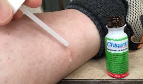 Check spelling or type a new query. How To Treat Chigger Bites