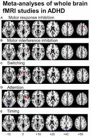 The brain of a person who has adhd tends to switch off during intense concentration. Frontiers Cognitive Neuroscience Of Attention Deficit Hyperactivity Disorder Adhd And Its Clinical Translation Human Neuroscience