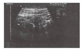 Image result for Neutropenic Colitis