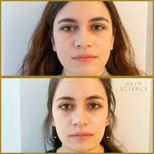 My Approach to Bruxism Treatment Using Botox