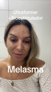 Diferença Ultraformer E Volnewer