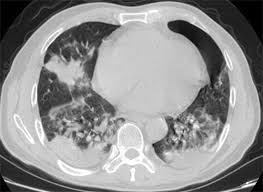 The general prognosis of lung cancer is poor because doctors tend not to find the disease until it is at an advanced stage. Performance Of Radiologists In Differentiating Covid 19 From Non Covid 19 Viral Pneumonia At Chest Ct Radiology