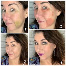 Would love some advice. I have had some under eye injections (redensity 1)  and have some swelling under my eye. It looks like they could bruise a bit.  I start a new