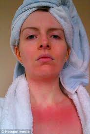 The woman so allergic to water that she can't even kiss her fiance