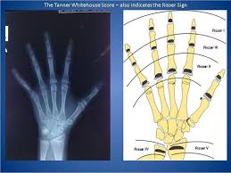 Image result for Risser Sign