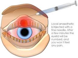 Wring it out so it's not dripping wet and then simply place it over the eye with the stye. Stye Treatment Surgery Top Rated Eye Doctor Nyc Ophthalmologist