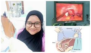 Kesihatan wanita masalah kesuburan masalah pasangan yang sukar dapat bayi punca tidak boleh hamil sebab lambat dapat bayi. Hanya Setahun Sekali Datang Haid Wanita Ini Kongsi Pengalaman Hidap Pcos