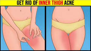 And this leads to an increased amount of sebum production or dead skin cells, which causes a buildup and clogging of sorts. How To Get Rid Of Inner Thigh Acne 5 Amazing Home Remedies For Inner Thigh Acne Youtube