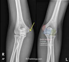 Image result for Lateral Condyle Fracture