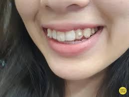 Malaysia silver rate (999 karat, 925 karat; I Swear By Teeth Straightening Service Zenyum But Here S The Catch Lifestyle News Asiaone