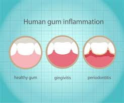 The best practices for healthy teeth and gums include regular brushing, flossing, and avoiding certain types of food and beverage. How To Take Care Of Your Gums Woodruff Dental Scottsdale Arizona