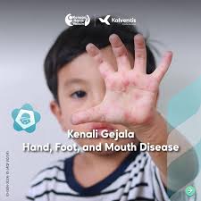 Meski HFMD dapat sembuh sendiri dalam jangka waktu 7