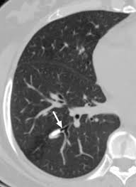 Image result for Broncholithiasis