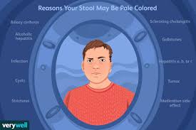 Image result for acholic stools human