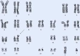 Bei ihm wurde der gendefekt, die sogenannte robertson translokation der chromosomen 14/21 festgestellt. Chromosomale Diagnostik Chromosomale Aberrationen Springerlink