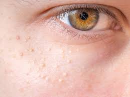 I have broken out with small itchy bumps on my forearms that itch very badly. Skin Bumps That Look Like Pimples But Aren T Insider