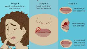 Herpes simplex virus, more commonly known as herpes affects 1 in 6 people. Cold Sore Outbreaks Causes Symptoms Stages Treatments