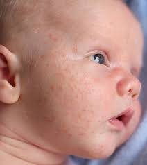 baby acne what causes them and how you can prevent