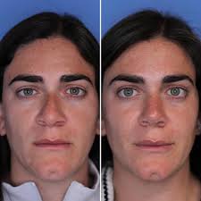 Rhinoplasty for this beauty! Before the transformation, our patients nose  dominated her features, casting a shadow