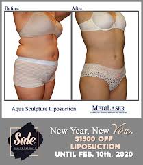 Look At Our Amazing Before And After Aqua Sculpting Liposuction Below Get Your Body Sculpted Beautiful Liposuction Procedure Liposuction Cosmetic Surgery