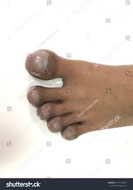 Image result for Clubbing nails feet