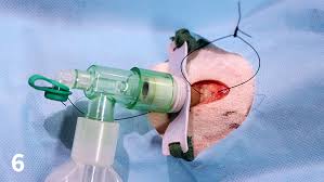 Image result for Tracheostomy