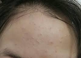 Top 10 cách trị mụn ở trán tại nhà hiệu quả nhất - Taza Skin Clinic