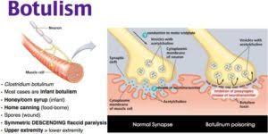 Maybe you would like to learn more about one of these? Botulism Symptoms Prevention Causes Treatment Dr Thind