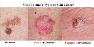 Carcinoma definition, a malignant and invasive epithelial tumor that spreads by metastasis and often recurs after excision; Types Of Cancer What Is Skin Cancer