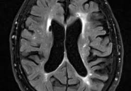 Alzheimer's disease, vascular dementia, lewy body dementia,. Vaskulaer Demens Nationalt Videnscenter For Demens