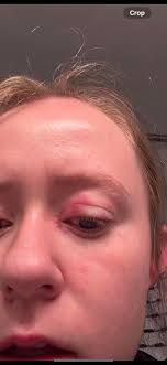 Why are my eyelids burning :(