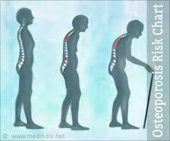 Osteoporosis Bone Disease Risk Chart