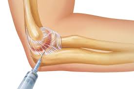 Image result for Septic Joint