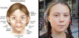 The eyes are slanted upward, and epicanthal folds at the inner corners usually are present. Fetal Alcohol Syndrome Microcephaly Small Palpebral Fissures Railroad Rack Ears Epicanthal Low Nasal Bridge Folds Flat Midface Upturned Nose Nose Smooth Philtrum Thin Vermilion Border Underdeveloped Jaw