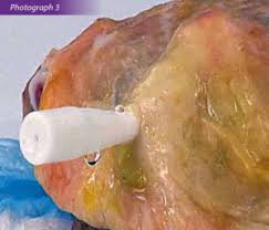 Image result for Bartholin's gland abscess