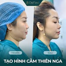 Cằm ngắn là gì? Cách khắc phục cằm tròn hiệu quả nhất!