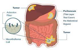 When cancerous tumors form on connective tissues, it is a sarcoma. Peritoneal Mesothelioma Treatment Prognosis Diagnosis