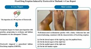 Image result for Fixed Drug Eruption