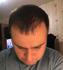 علاجك الطبية زراعة الشعر للرجال في تركيا 2020 hair transplant transplant hair